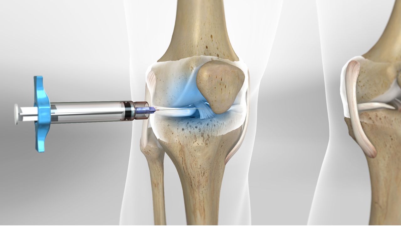 Joint Replacement Surgery